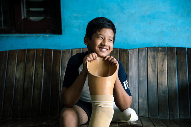 Enfant souriant posant avec sa prothèse.